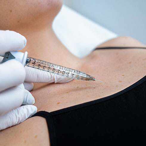 Injections d'acide hyaluronique pour le décolleté