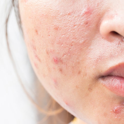 Traitements et soins anti-acné