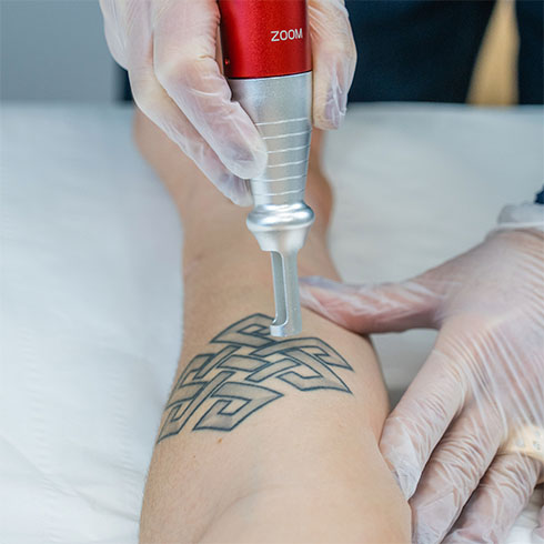 Détatouage : enlever votre tatouage par laser