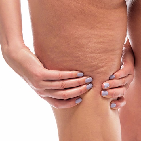 Les traitements contre la cellulite